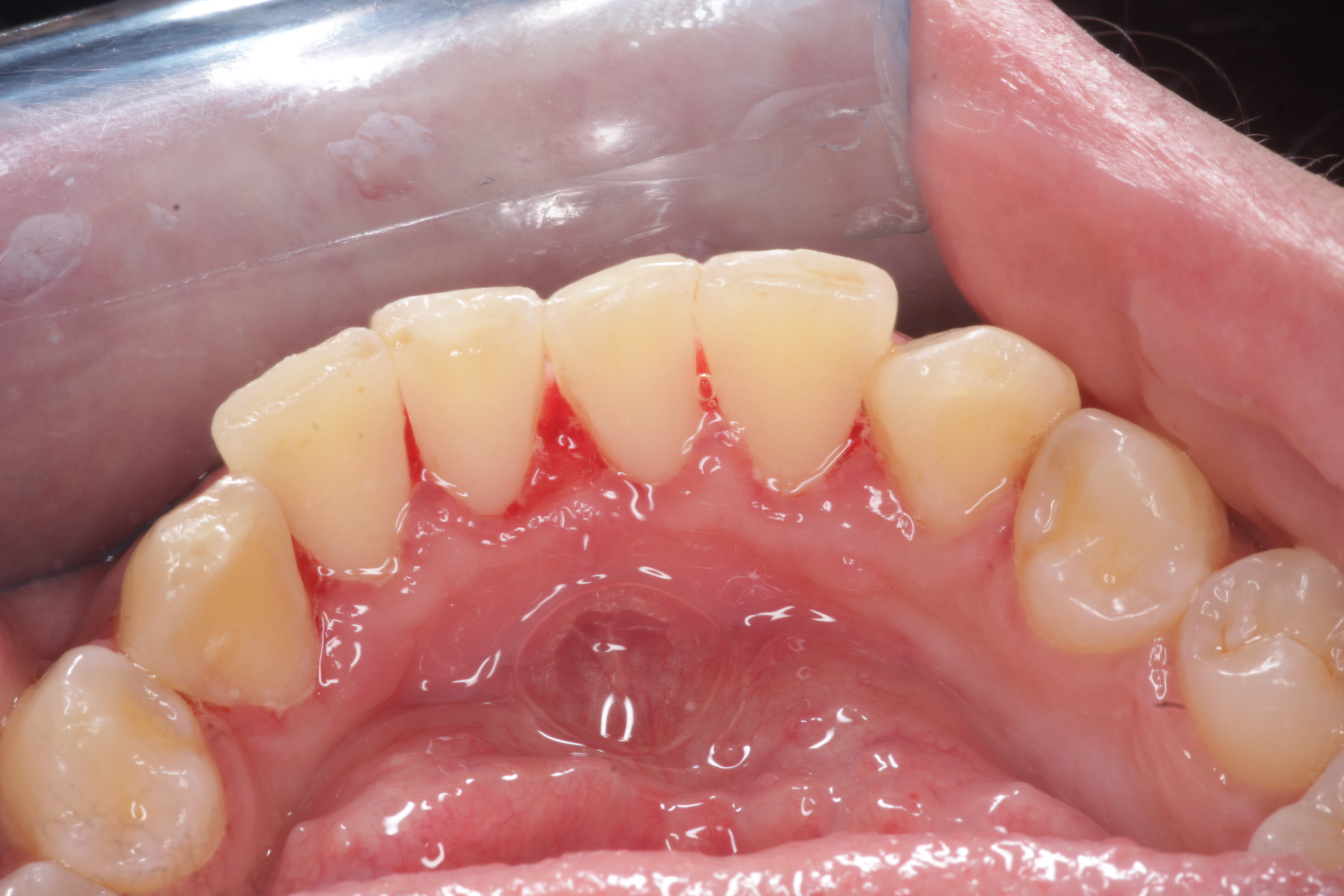 Teeth After Cleaning